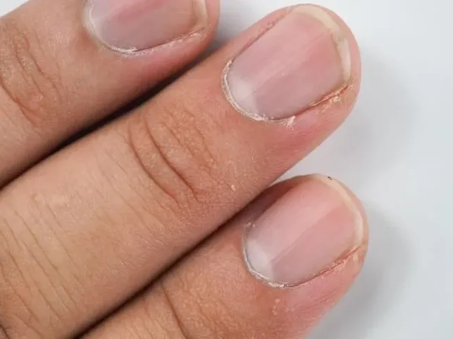 피부과에서 손톱을 확인하는 장면