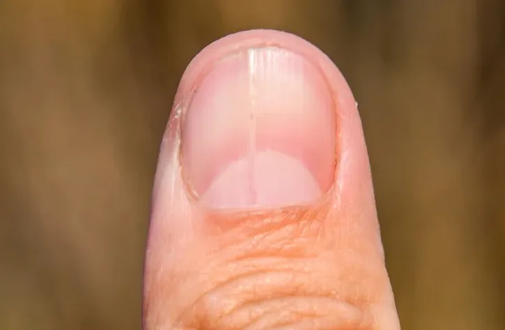 손톱 흑색종 의심 소견을 보여주는 사진