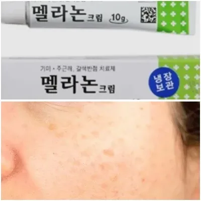 멜라논크림 처방 가격 사용법과 주의사항 정리 9