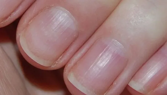 손톱 색소 침착이 보이는 확대 사진